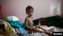 FILE - A malnourished boy sits on a bed at a malnutrition treatment center in Sanaa, Yemen, Oct. 30, 2016. 