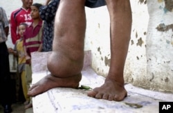 FILE - Seorang pasien filariasis limfatik (kaki gajah), di Garawan, Mesir, tahun 2004. (AP/Hasan Jamali)