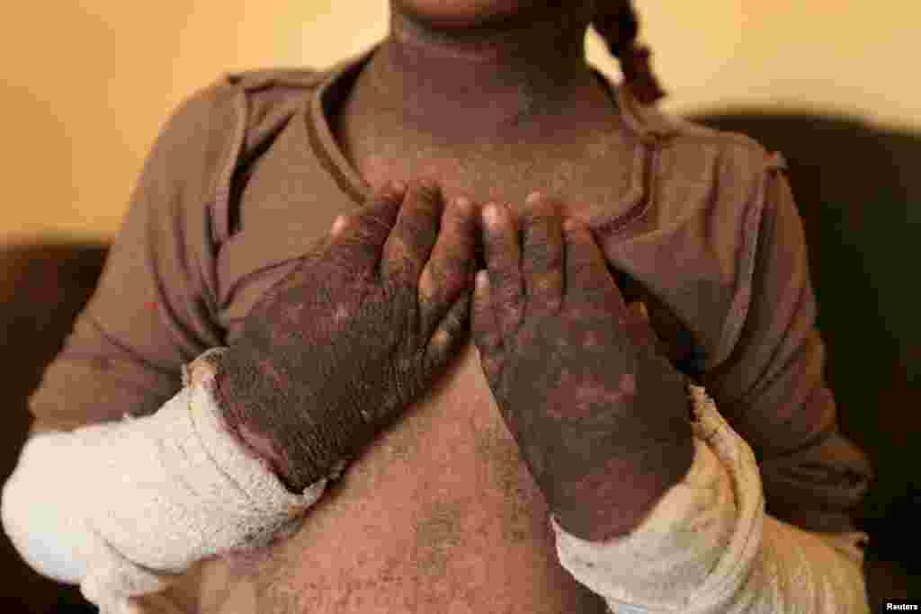 The skin on five-year-old Doaa&#39;s arms and neck is blackened after a rocket fired by Islamic State landed and exploded in Qayyara, Iraq, Nov. 12, 2016.