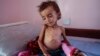 Bayi Intoleran Laktosa Menderita di Yaman