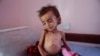 Дитина з Ємену, яка страждає від голоду та виснаження. AP Photo/Hani Mohammed) 