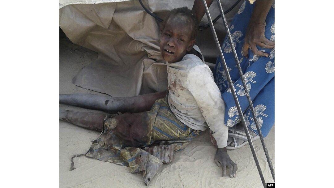 A Doctors Without Border (MSF) handout photo distributed Jan. 17, 2017, shows a wounded child after following the bombing by a Nigerian Air Force jet of a camp for those displaced by Boko Haram Islamists, in Rann, northeast Nigeria.