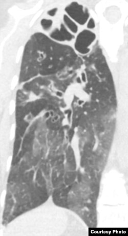 In this x-ray image, Pseudomonas infection in a lung is most visible at the top of the organ, which appears as a torn shroud over cavities. (Singh Lab, University of Washington)