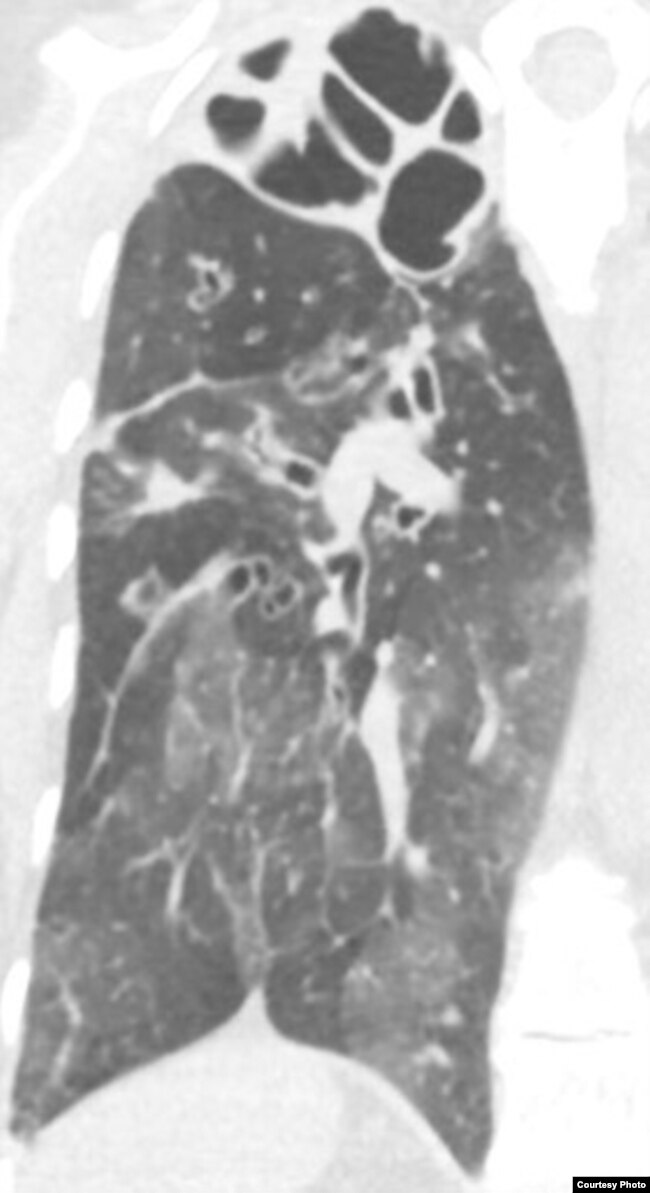 In this x-ray image, Pseudomonas infection in a lung is most visible at the top of the organ, which appears as a torn shroud over cavities. (Singh Lab, University of Washington)