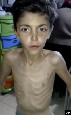 An emaciated Syrian boy receives treatment at a local field clinic in Madaya, Syria in this image made from video posted online on Jan. 8, 2016 by Madaya Medical Corps.