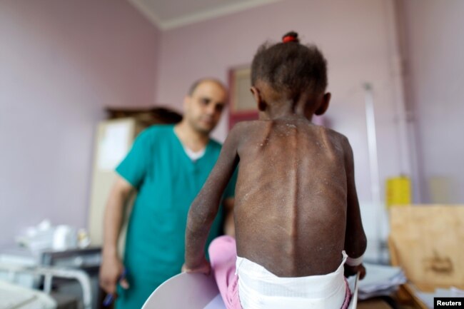 FILE - A nurse looks as he weighs a malnourished girl at a malnutrition treatment center in Sana'a, Yemen, Oct. 7, 2018.