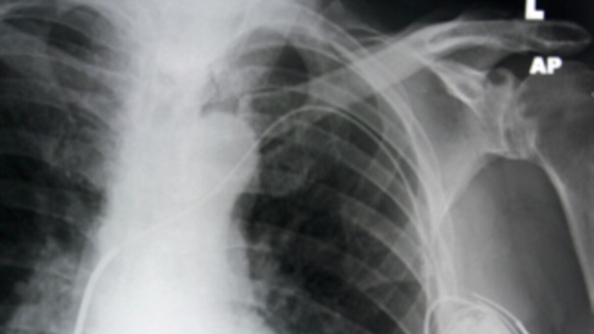 Reused Pacemakers May Aid Heart Care in Developing World