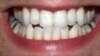 Common Chemical May Damage Teeth