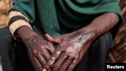 A Sudanese woman, pictured on August 5, 2023 in Adre, Chad, shows burn scars on her hands that she said she sustained in April 2023, after Rapid Support Forces (RSF) and Arab militia forces torched the displaced-persons camp where she was living in El Geneina.