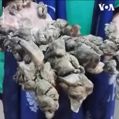 ‘Người Cây’ Bangladesh trở lại bệnh viện