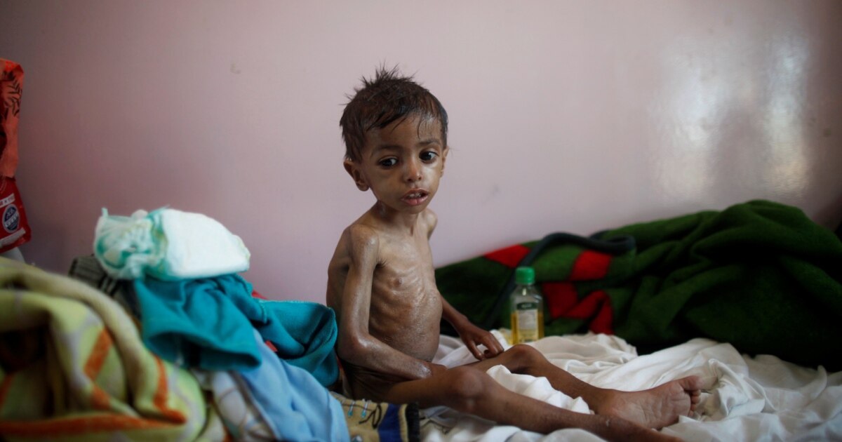 UN Agency: Child Malnutrition at 'All-time High' in Yemen