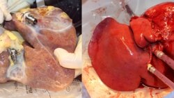 On the left a non-perfused liver, on the right a liver treated with the new machine. (Image: University Hospital Zurich/beamue)