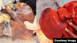 On the left a non-perfused liver, on the right a liver treated with the new machine. (Image: University Hospital Zurich/beamue)