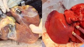 On the left a non-perfused liver, on the right a liver treated with the new machine. (Image: University Hospital Zurich/beamue)