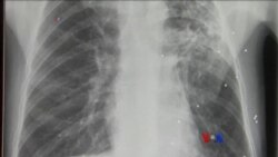 ဗြိတိန်က တီဘီရောဂါတိုက်ဖျက်ရေး