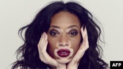 Vitiligo