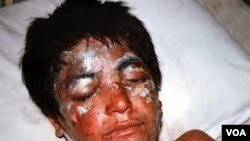 Sardasht Chimical Attack