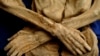 Mummies Contain Clues to Colon Cancer 