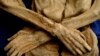 Mummies Contain Clues to Colon Cancer 