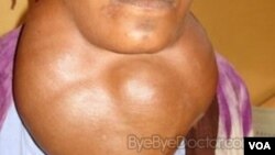 Goiter