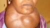 Goiter