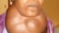 Goiter