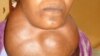 Goiter