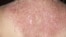 Peau d'une personne atteinte de de lupus rhumatoïde.