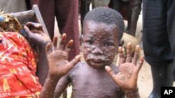 This 7-year-old Congolese child developed monkeypox after hunting squirrels in the forest surrounding her village.