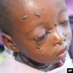 This Somali child is suffering from measles and malnutrition.