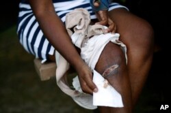 FILE - Keishonna Williams, age 18, uncovers a bandage revealing a bullet wound on her leg in Newark, Delaware, Aug. 9, 2017.