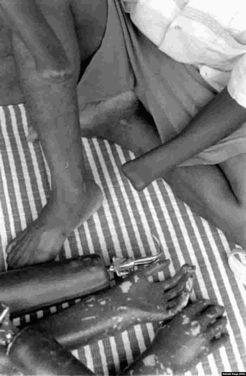 Un homme amputé par les rebelles en Sierra Leone, dans un camp de réfugiés en Guinée, 2000. (Nathalie Barge, VOA)