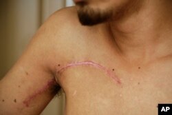An anti-government university student, who did not want to be identified for fear of government reprisals, shows his scars after surgery to extract a bullet from his shoulder, in Managua, Nicaragua, July 27, 2018. Among those in hiding is this 20-year-old who lost much of the mobility in his right arm and hand after being shot by security forces on June 23 while helping treat wounded students as they came under fire.