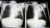 US Approves Drug-Resistant Tuberculosis Treatment