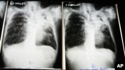X-rays from a tuberculosis patient at A. G. Holley Hospital in Lantana, Florida, Dec. 2009 (file photo).