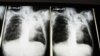 Study: Childhood TB Rates Much Higher than Estimated