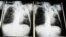 X-rays from a tuberculosis patient at A. G. Holley Hospital in Lantana, Florida, Dec. 2009 (file photo).