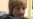 Young Romanian Burn Victim Gets Help in California