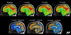 This series of PET brain scan images provided by Mount Sinai in 2024 shows changes in patient Emily Hollenbeck with deep brain stimulation therapy. (Mount Sinai via AP)