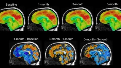 Quiz - Electrical Device in Brain Might Help with Depression