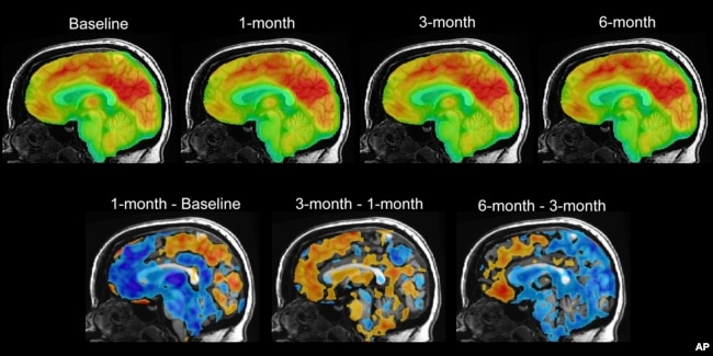 This series of PET brain scan images provided by Mount Sinai in 2024 shows changes in patient Emily Hollenbeck with deep brain stimulation therapy. (Mount Sinai via AP)