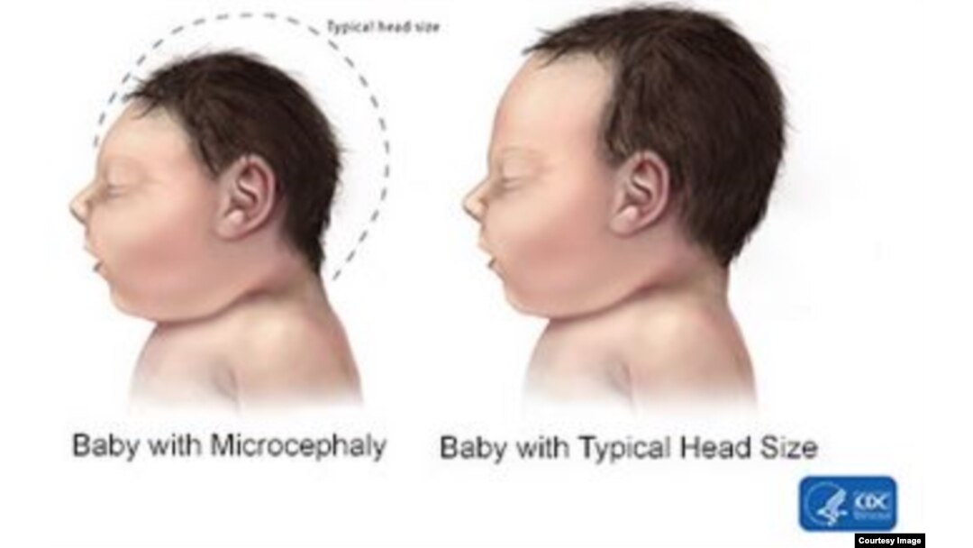 Microcephaly, illustrated on CDC website
