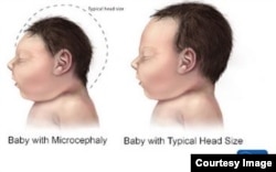 Microcephaly, illustrated on CDC website