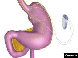 El implante envía señales al cerebro.