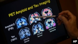 R. Scott Turner, Professor of Neurology and Director of the Memory Disorder Center at Georgetown University Hospital, points to PET scan results that are part of a study on Allheimer's disease at Georgetown University Hospital, on Tuesday, May 19, 2015, in Washington. Amyloid plaques are the Alzheimer’s culprit that gets all the attention. Now scientists are beginning to peer into the brains of people considered at high risk of getting Alzheimer’s to see if the disease’s other bad actor, tangle-forming tau, is lurking well before any memory symptoms begin. (AP Photo/Evan Vucci)
