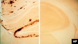 Gambar sebelah kiri menunjukkan bagian-bagian otak penderita penyakit Alzheimer, di mana protein menumpuk dan membentuk plak yang mengeras, sementara gambar di sebelah kanan menunjukkan bagian otak yang berhasil dibersihkan dari timbunan plak dengan pemberian vaksin untuk merekayasa antibodi yang sedang dikembangkan tim peneliti AS (AP Photo/Elan Corp.).