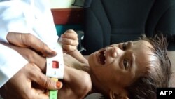 Ahmed Abdo Salem, a two-year-old Yemeni child displaced by conflict suffering from malnutrition is measured at a health clinic in the war-ravaged western Hodeida province.