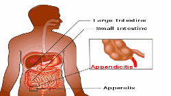 အူအတတ်ရောင် - Appendicitis