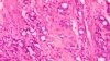 Radiation Drugs Hunt and Kill Cancer Cells