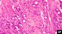This 1974 microscope image made available by the Centers for Disease Control and Prevention shows changes in cells indicative of adenocarcinoma of the prostate. 